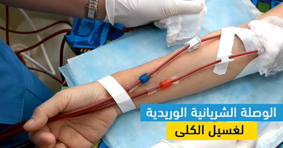 الوصلة الشريانية الوريدية لغسيل الكلى